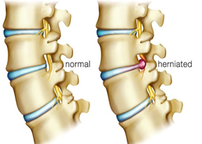 Image result for slipped disc treatment