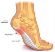 Image result for plantar fasciitis